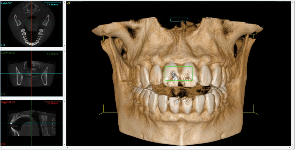 صورة توضح فحص CBCT للفك، مع إظهار بنية عظم الفك وتخطيط مواضع زراعة الأسنان.