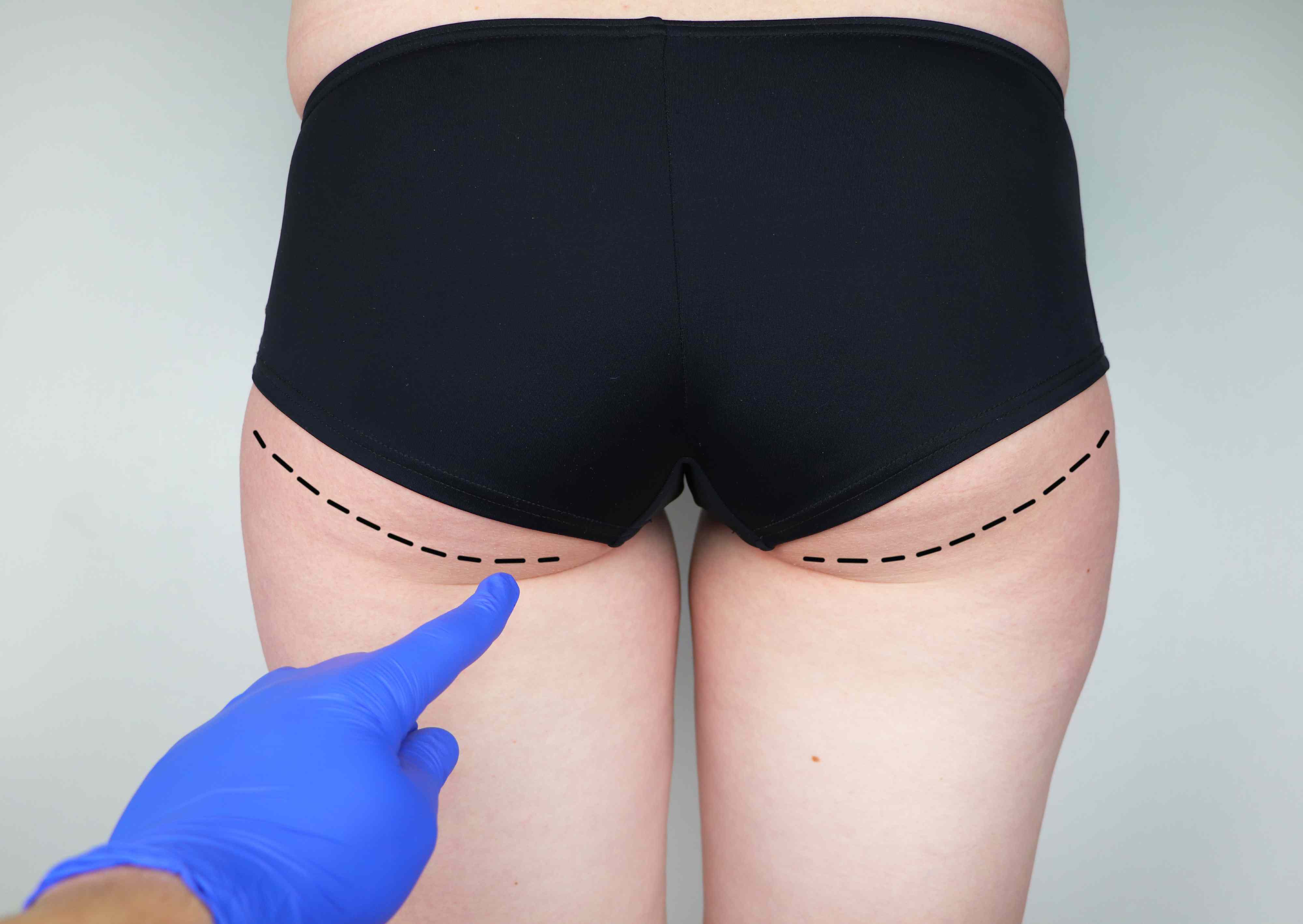 Female body before BBL surgery.
