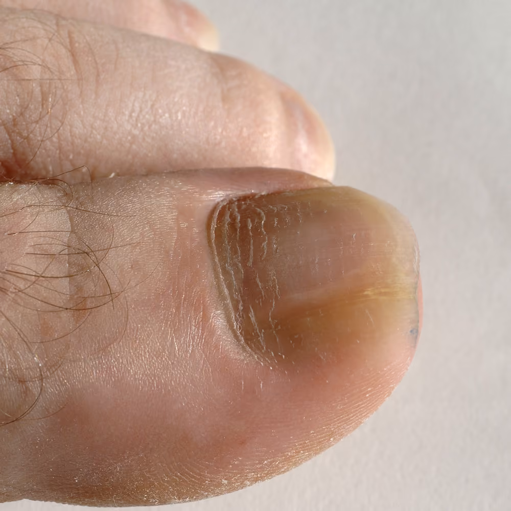 Close-up of a man's toenail fungus.