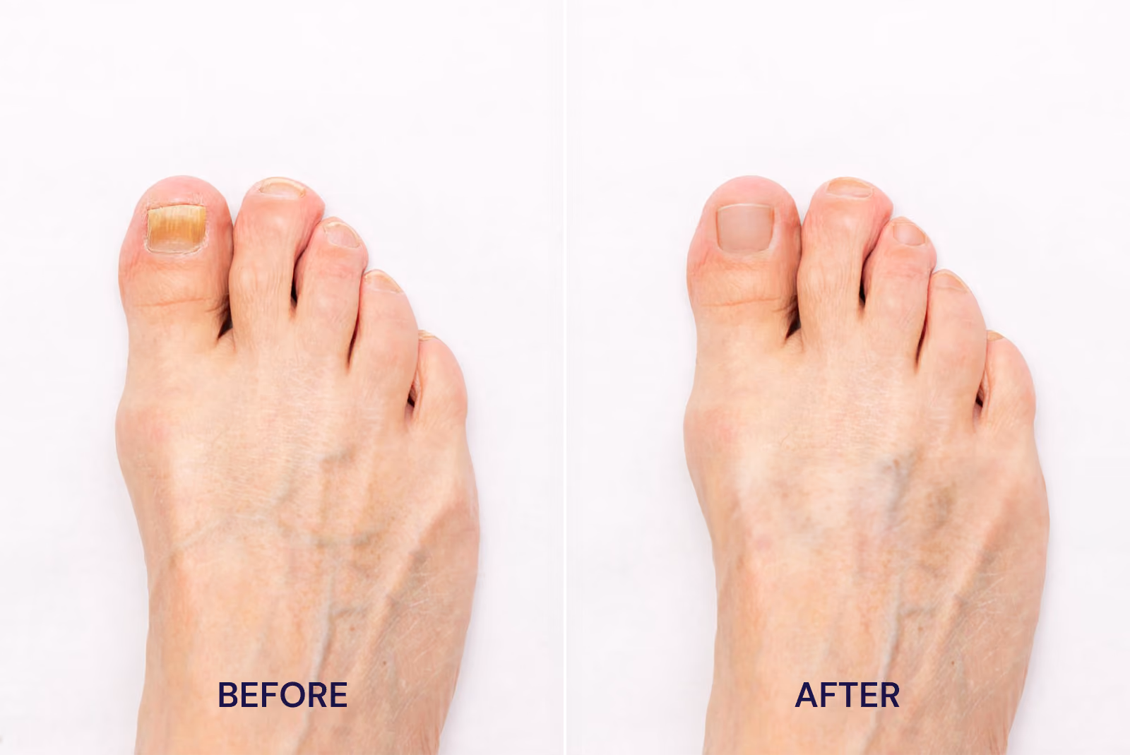 Before and after photo of toenail fungus STRIDE treatment.