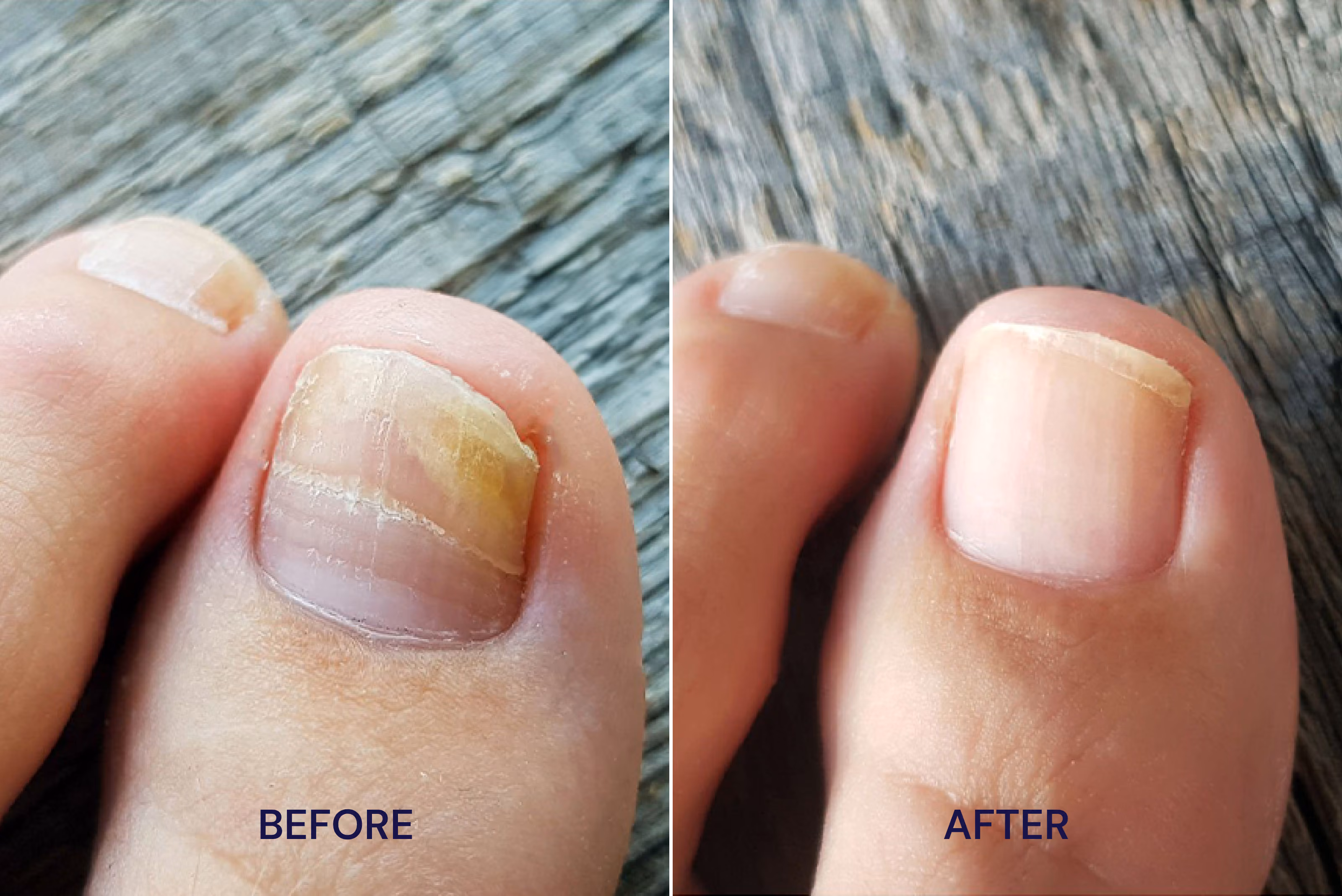 Close-up photo of before and after treatment of toenail fungus with STRIDE treatment.