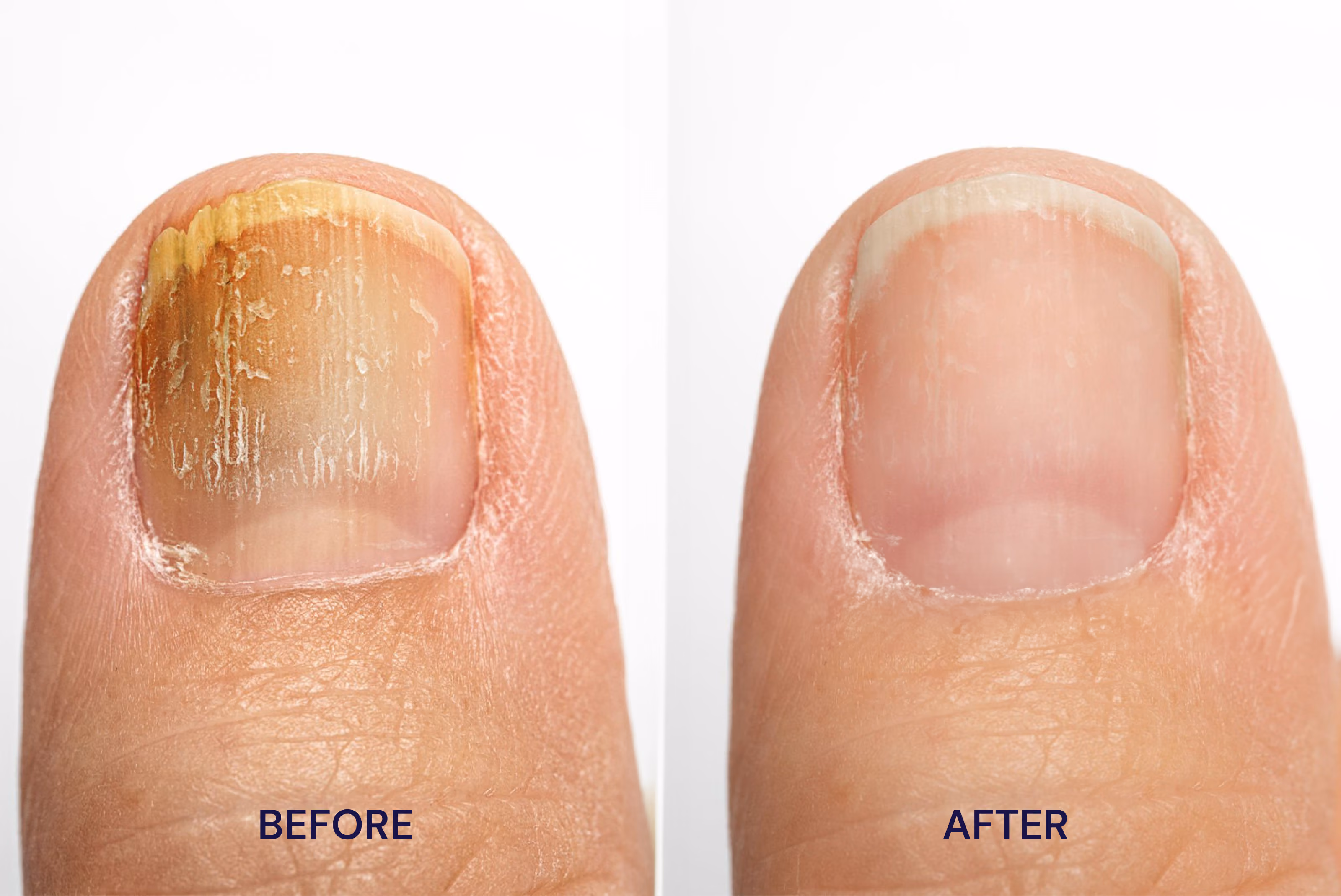 Close-up of the big toe before and after treatment of fungus with STRIDE.