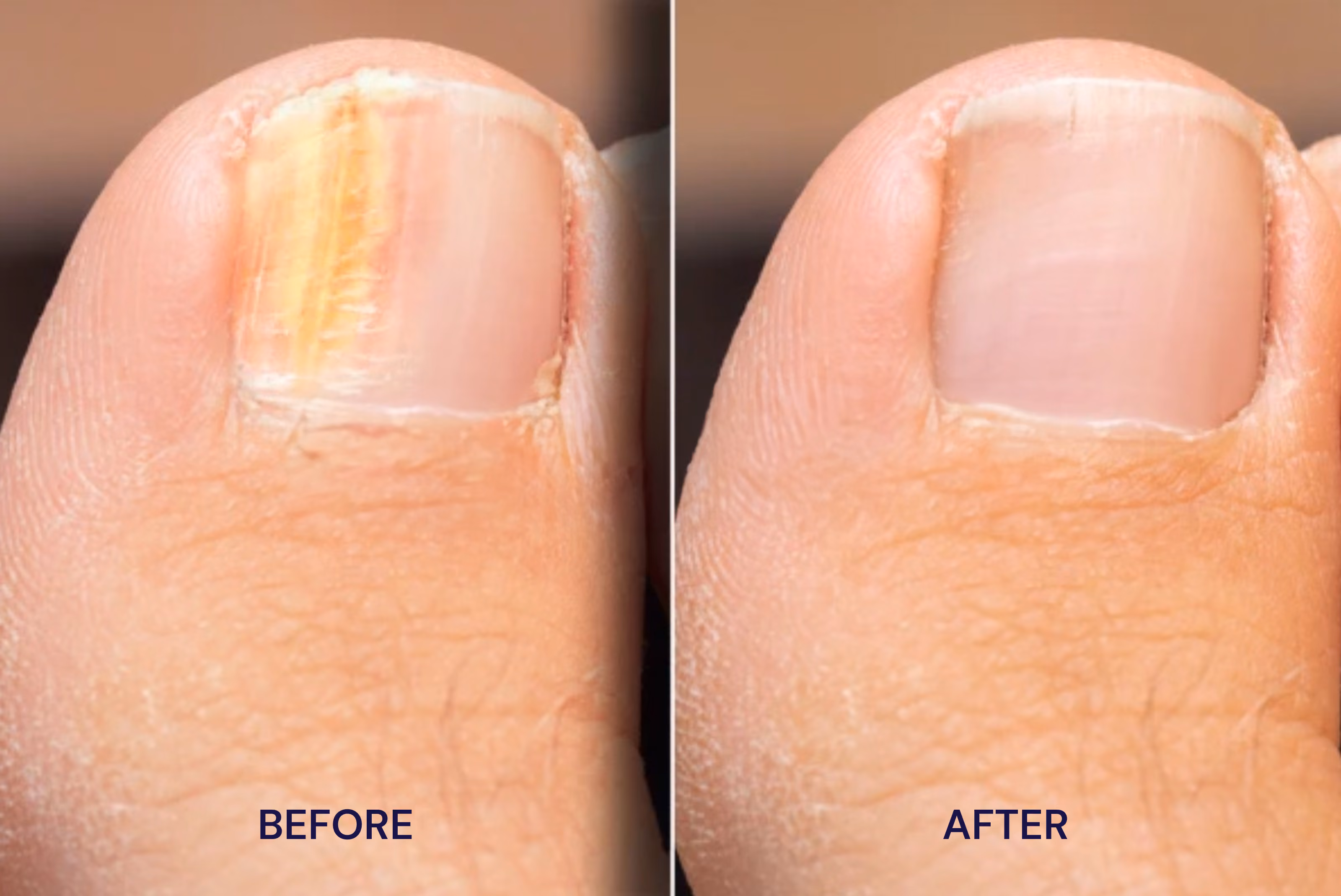 Close-up of toenail before and after recovery from toenail fungus with STRIDE medication.