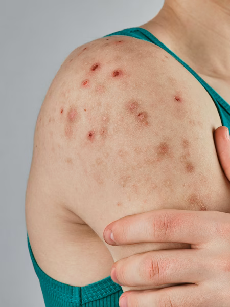 Image of woman's right shoulder and back with severe body acne and "backne"