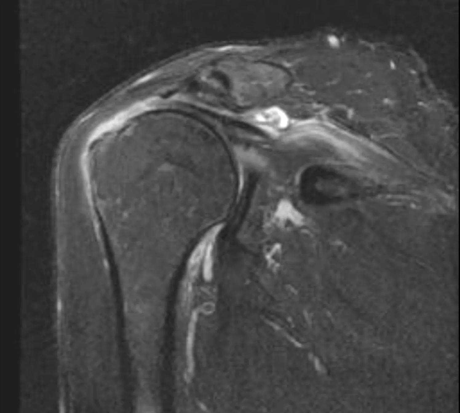 Example shoulder MRI