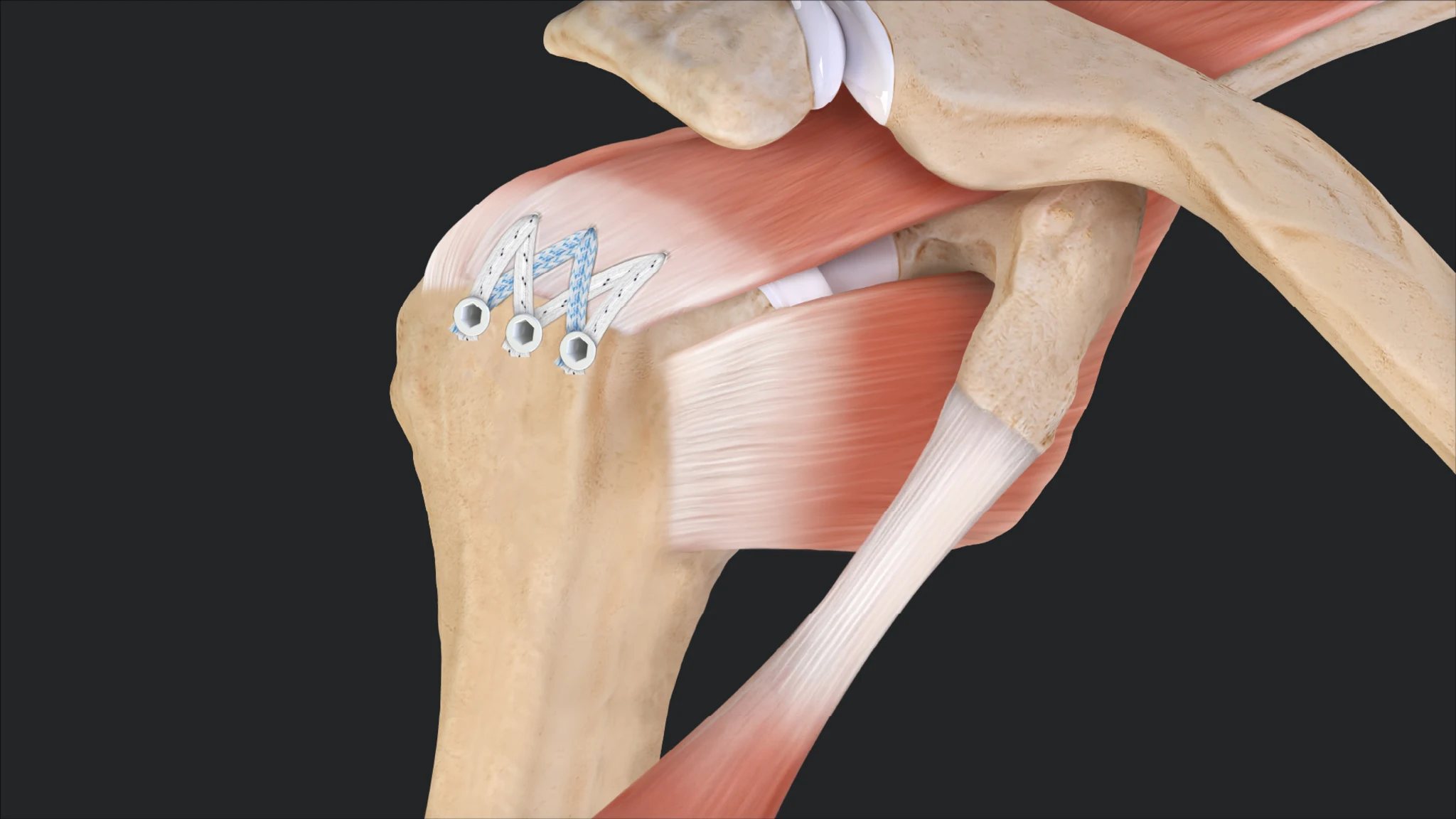Patient discussing shoulder recovery and satisfaction with a surgeon