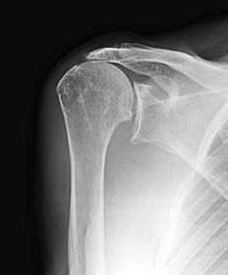 X-ray showing superior migration of the humeral head