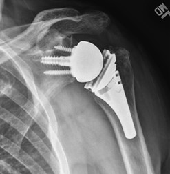 X-ray of a reverse shoulder replacement