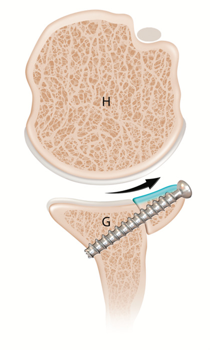Latarjet coracoid bone graft