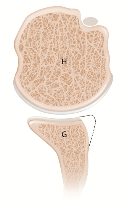 Assessment of glenoid bone loss