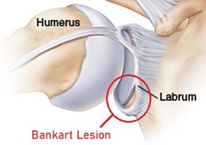 Bankart tear of the anterior labrum