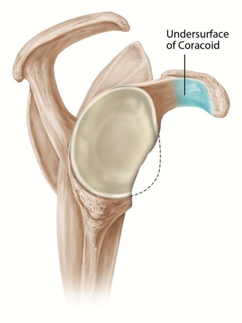 Glenoid bone loss after repeated dislocations