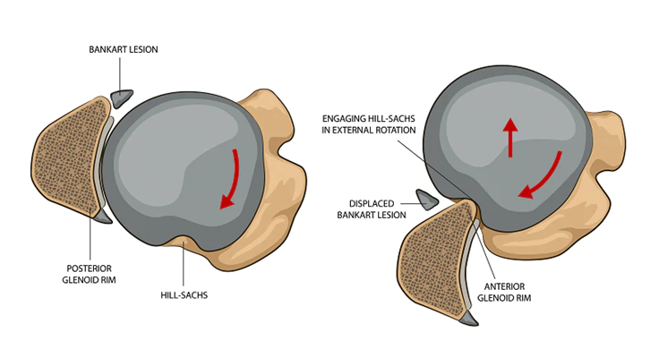 Hill-Sachs lesion on the humeral head