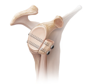 Latarjet fixation on X-ray