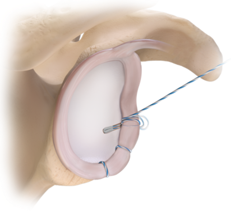 Labral repair with suture anchors