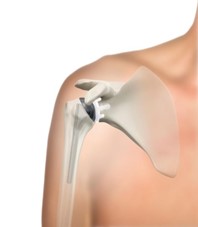 Anatomic total shoulder replacement
