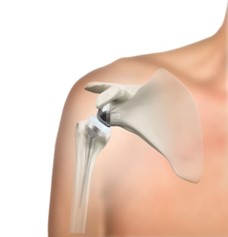Reverse total shoulder replacement