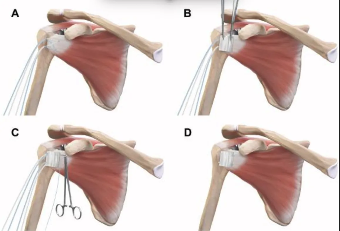 Surgical illustration of a biceps tendon patch placed over the subscapularis repair site