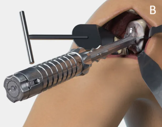 Surgical illustration showing an arthroscopic instrument used during shoulder joint surgery.