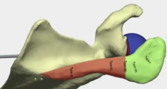 Illustration of shoulder anatomy highlighting the acromion, scapula and humerus