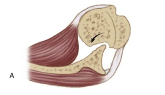 Illustration of a shoulder dislocation showing a Hill-Sachs lesion on the humeral head.