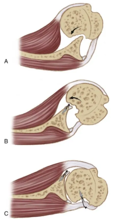 Diagram of the remplissage procedure attaching rotator cuff tendon into the humeral head defect