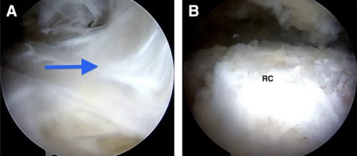 Arthroscopic images of the space above the rotator cuff before and after clearing scar tissue