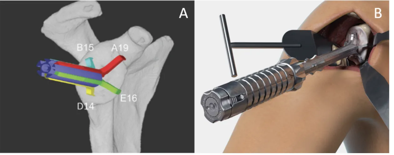3D preoperative planning software with patient anatomy and patient-specific instrumentation
