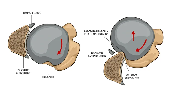 Hill-Sachs lesion on the humeral head