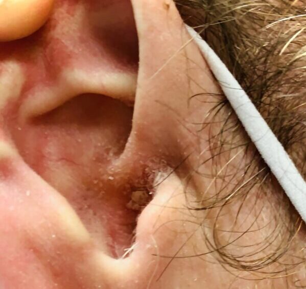 Living the Itching Ear Nightmare! - Advanced ENT & Allergy | Sinus Sleep  Thyroid Hearing