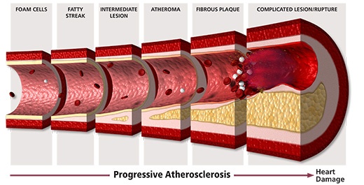 4 Ways to Get Healthy Arteries and a Healthy Heart – Boston Heart