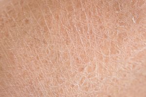Dry Skin - Canadian Dermatology Association