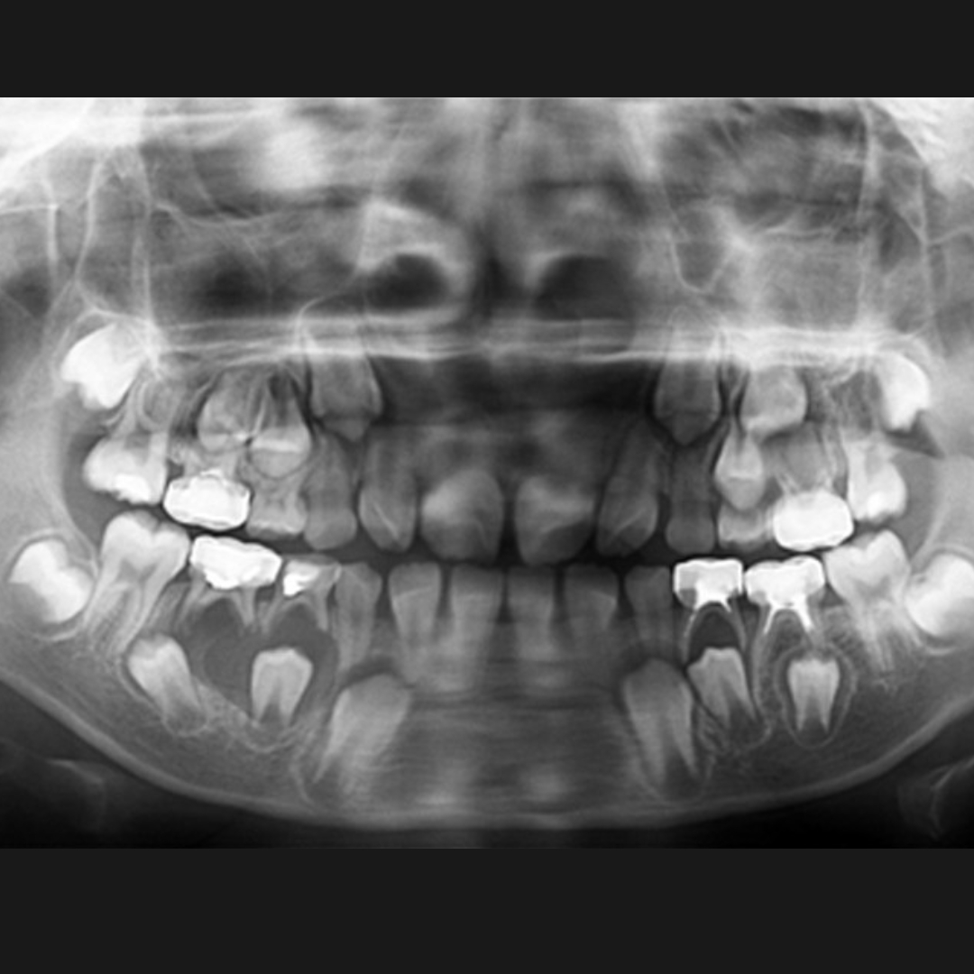 рентгенова снимка на детски зъби