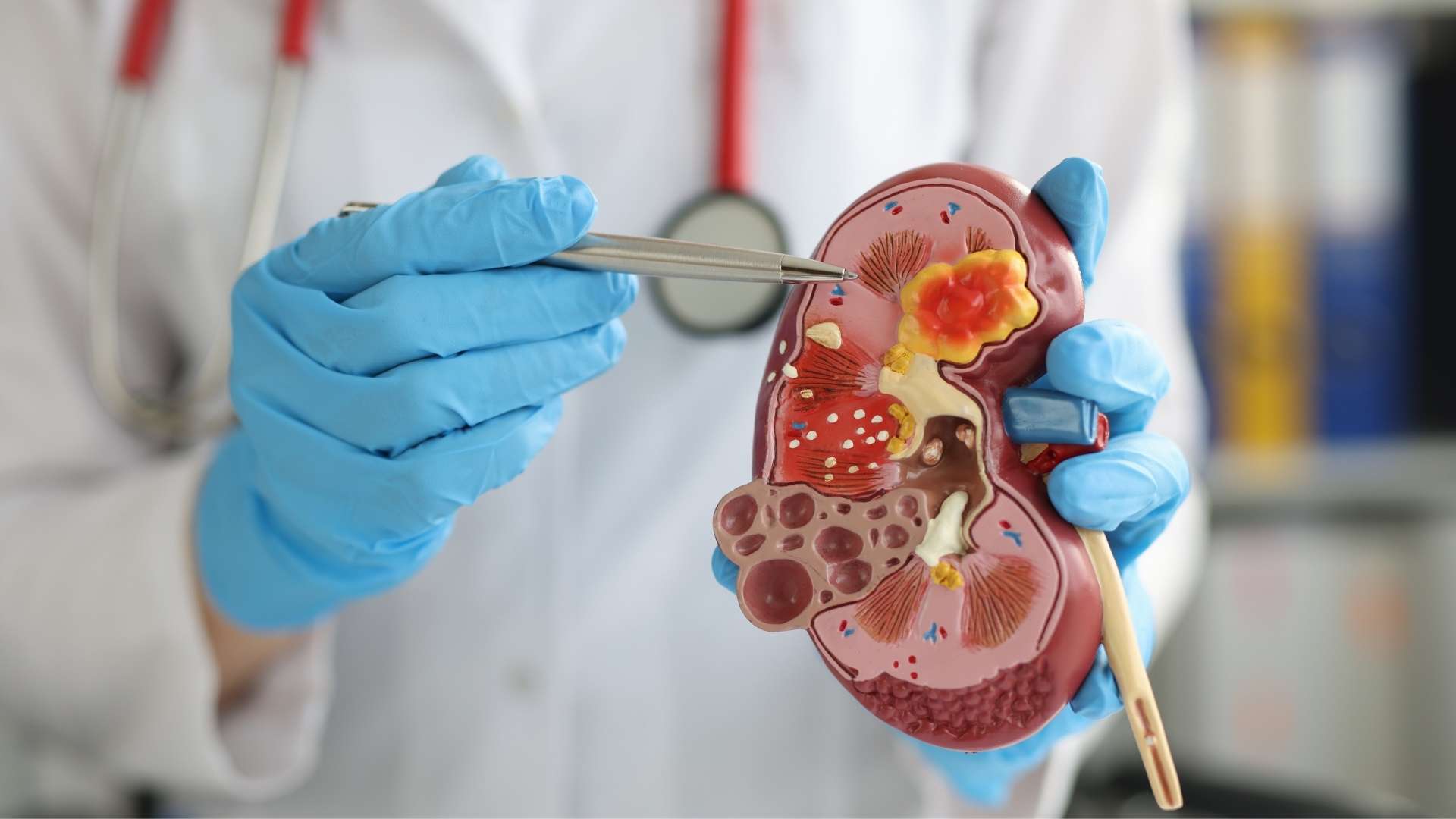 A doctor points at a model of a kidney with kidney stones