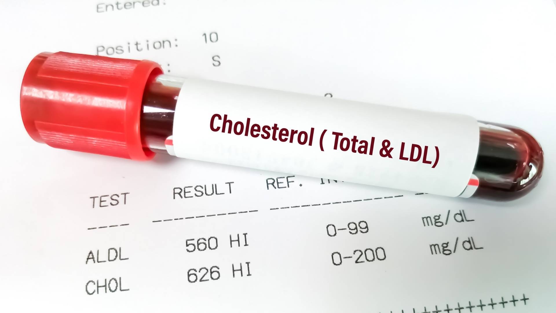 A blood vial with a label that reads 'cholesterol'