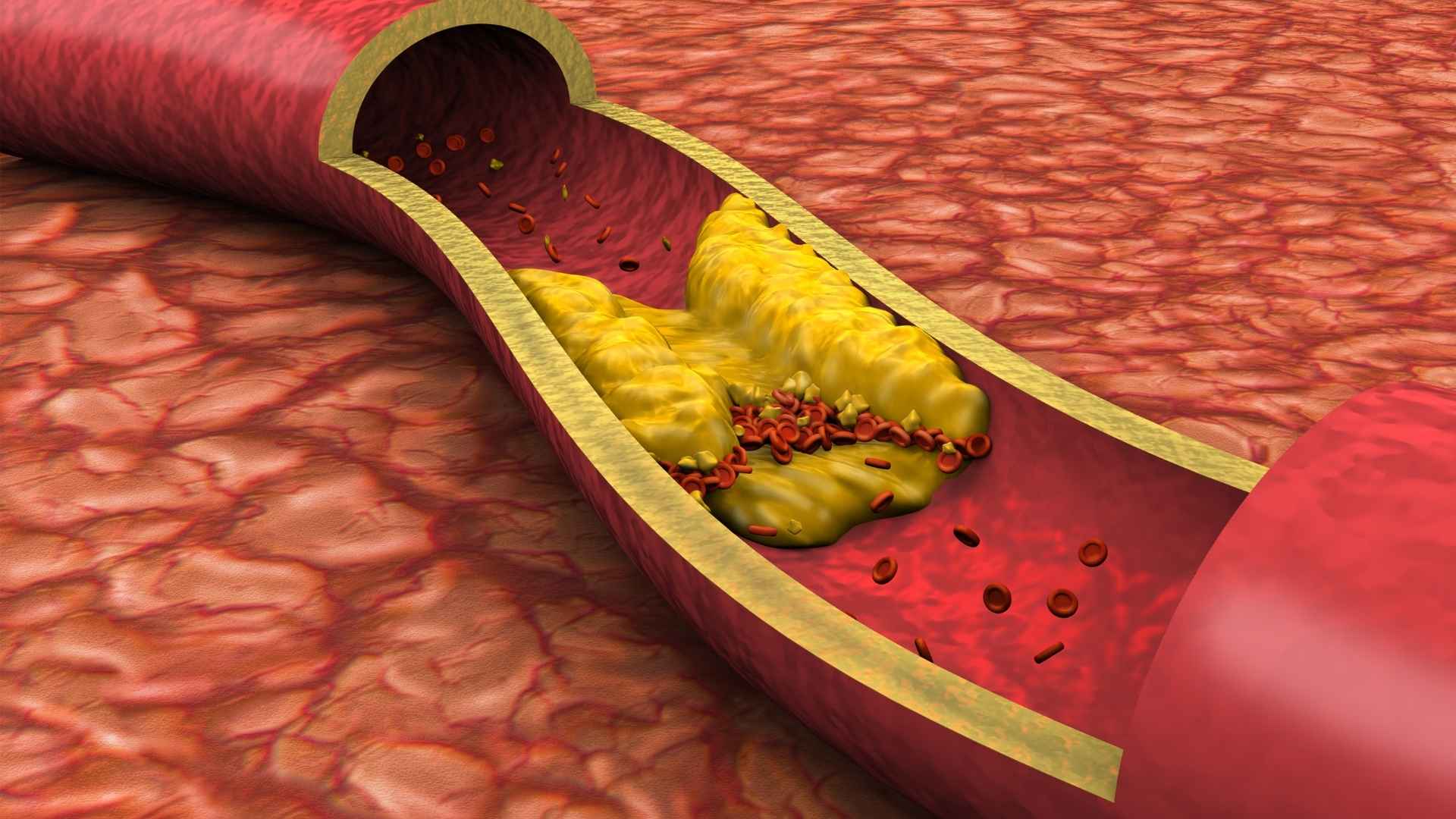 An artery is blocked with cholesterol
