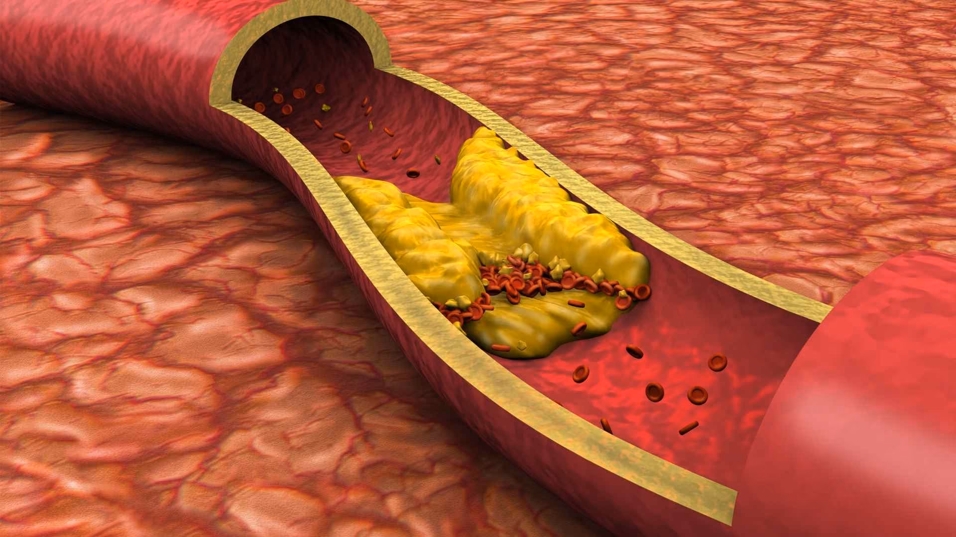 A vein is full of cholesterol, blocking the flow of red blood cells