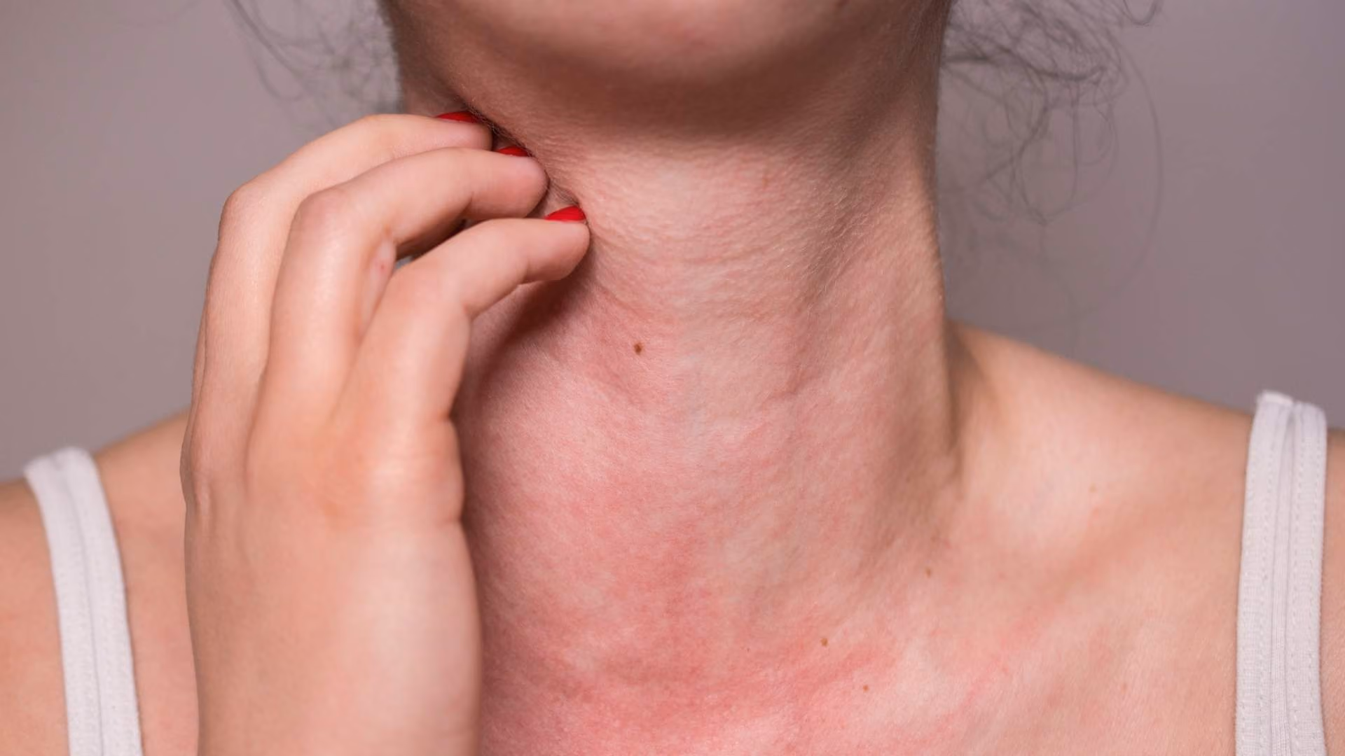 A woman scratches a rash on her neck