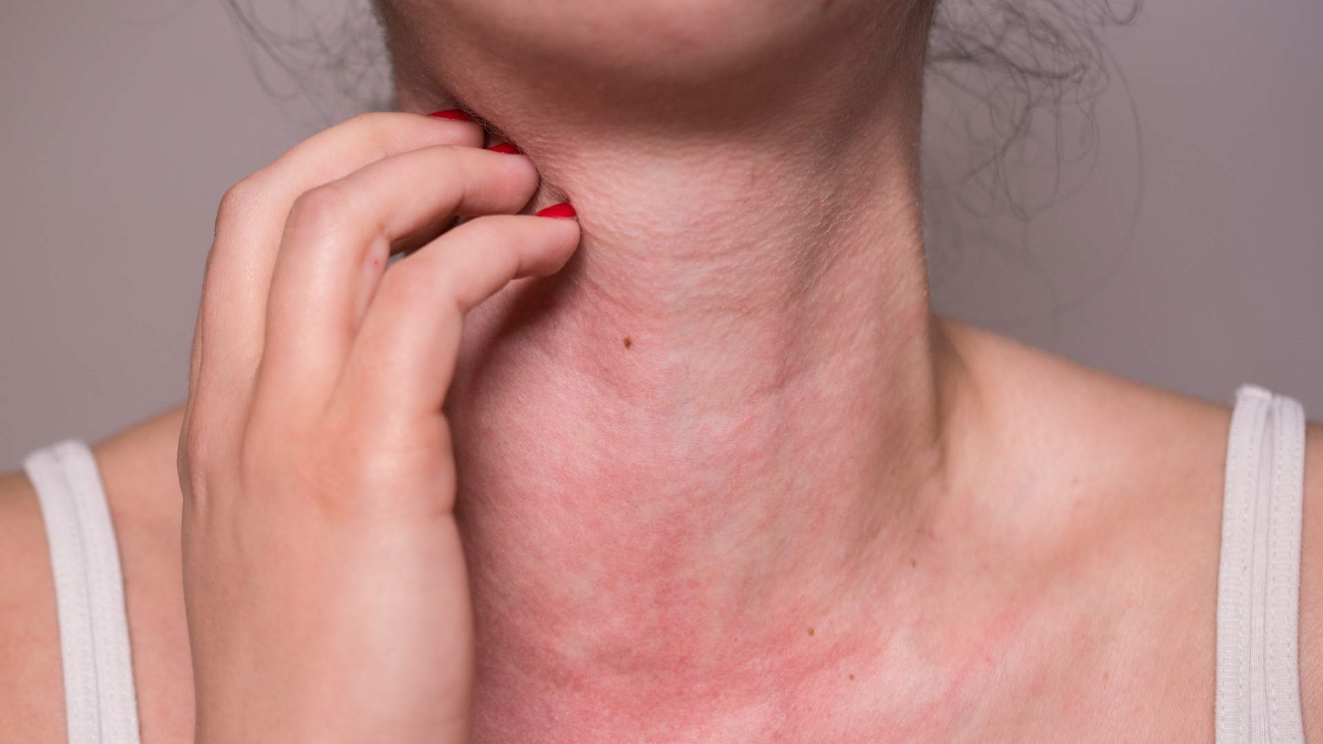 A woman scratches a rash on her neck