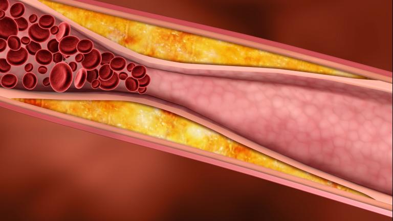 Blood flow in an artery is being restricted by the build up of yellow fat along the walls of the artery.