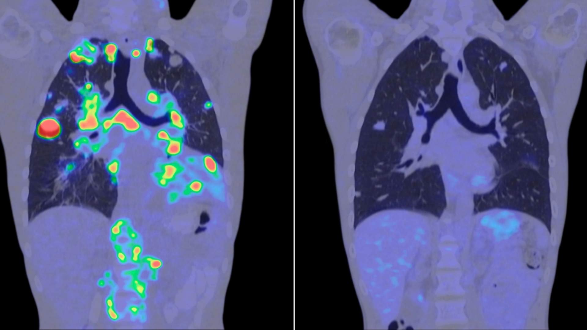 CT scan showing tumours in a body
