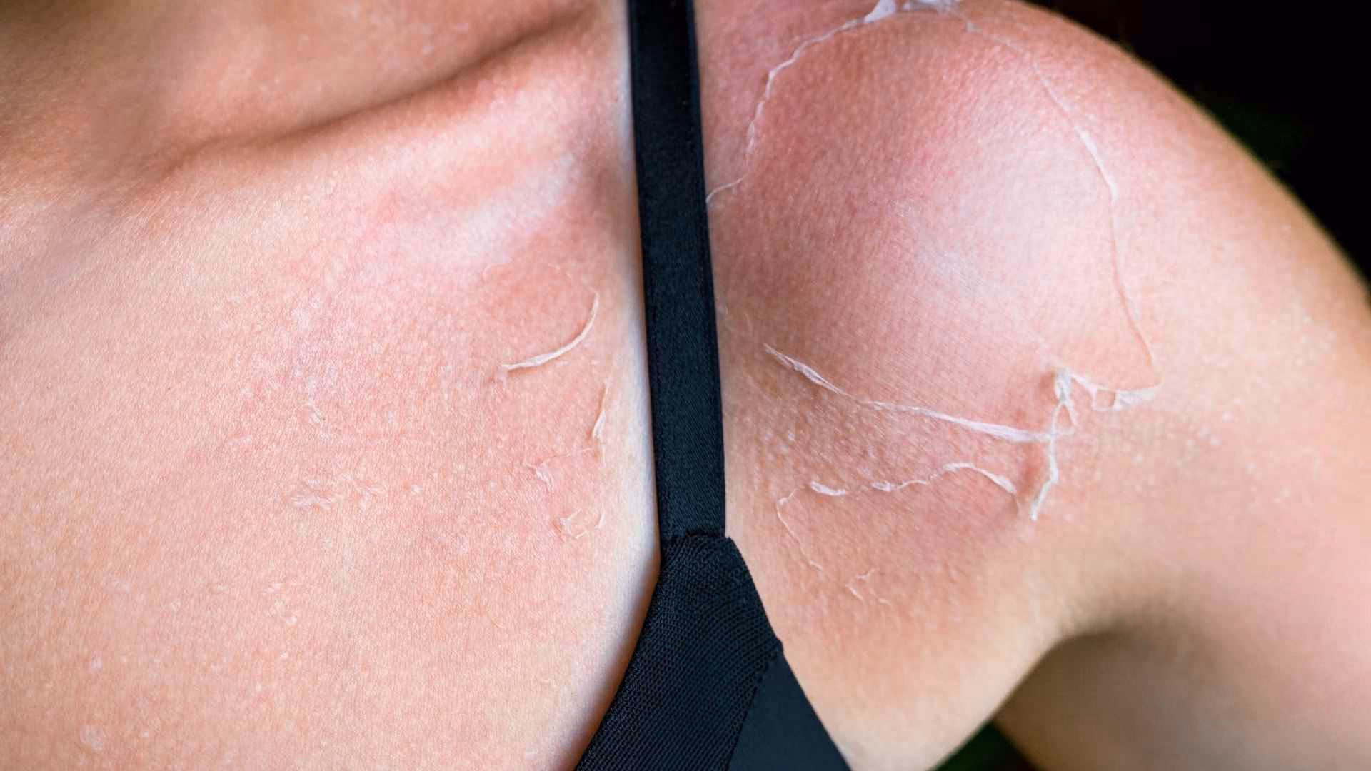 A person with peeling skin