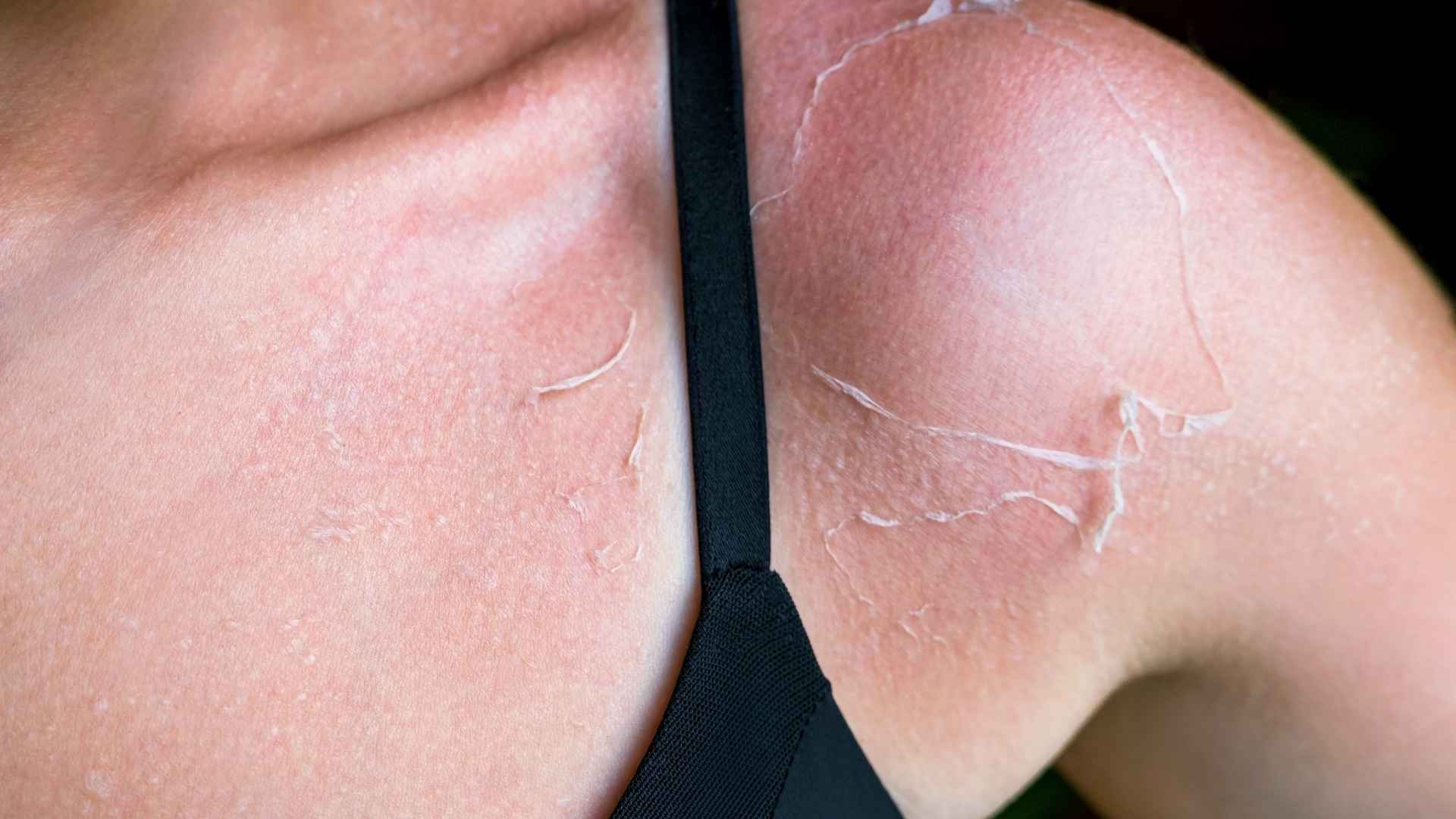 A person with peeling skin