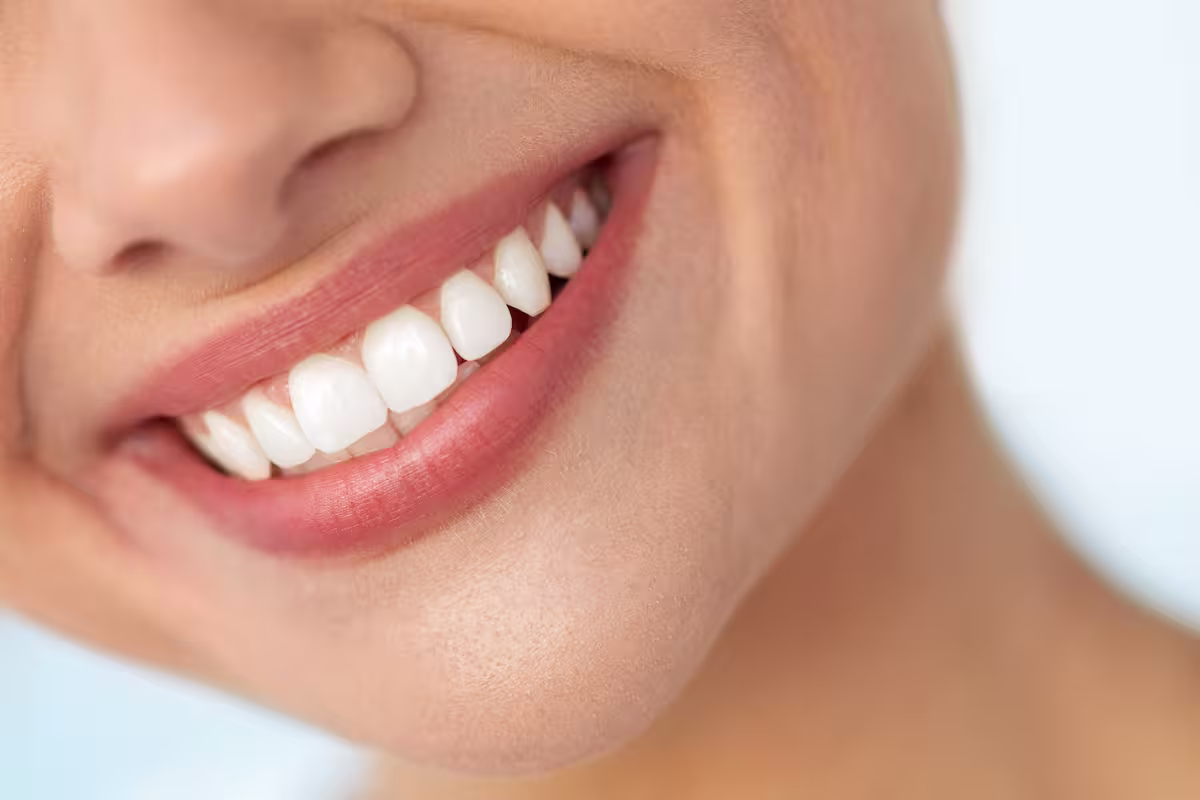 Veneers