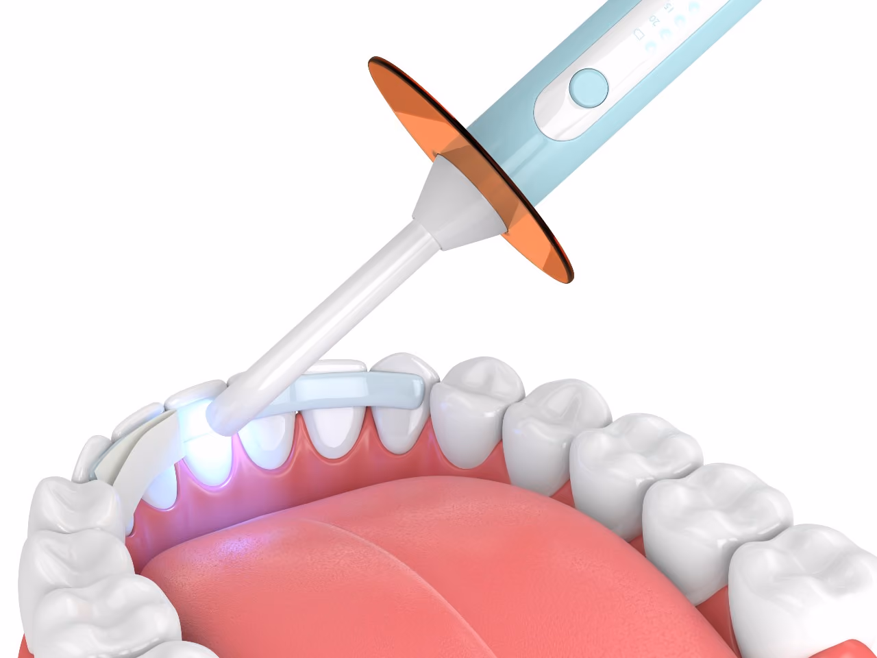 Is Dental Bonding Permanent?
