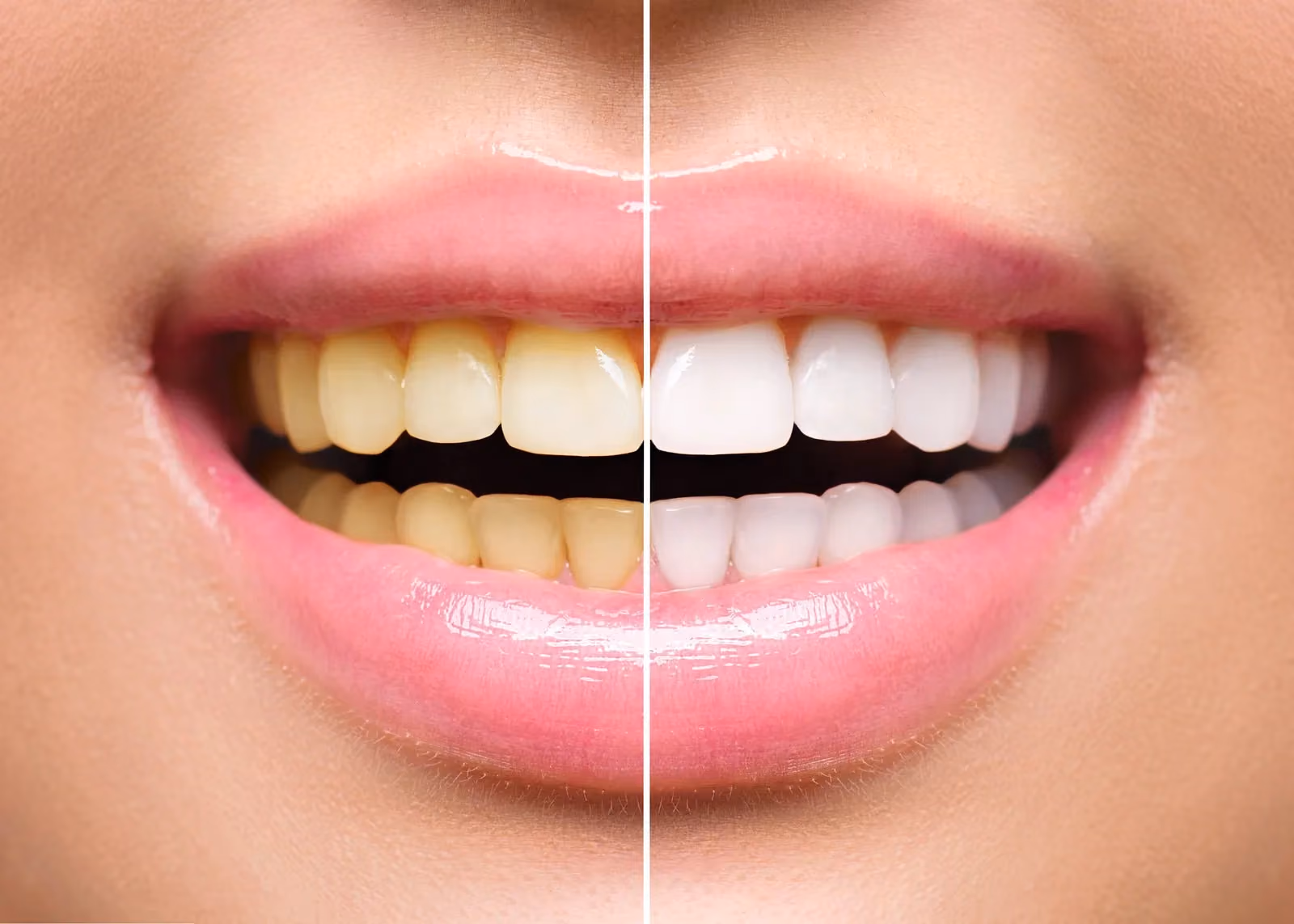 Dental Restorations