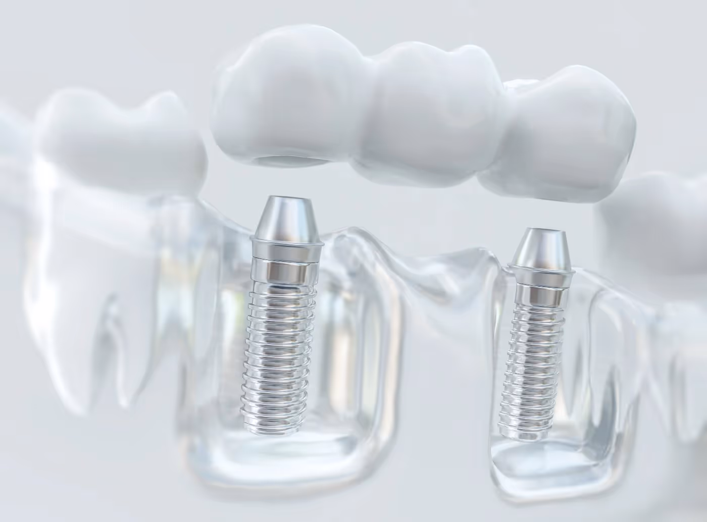 Dental Implants in Dublin