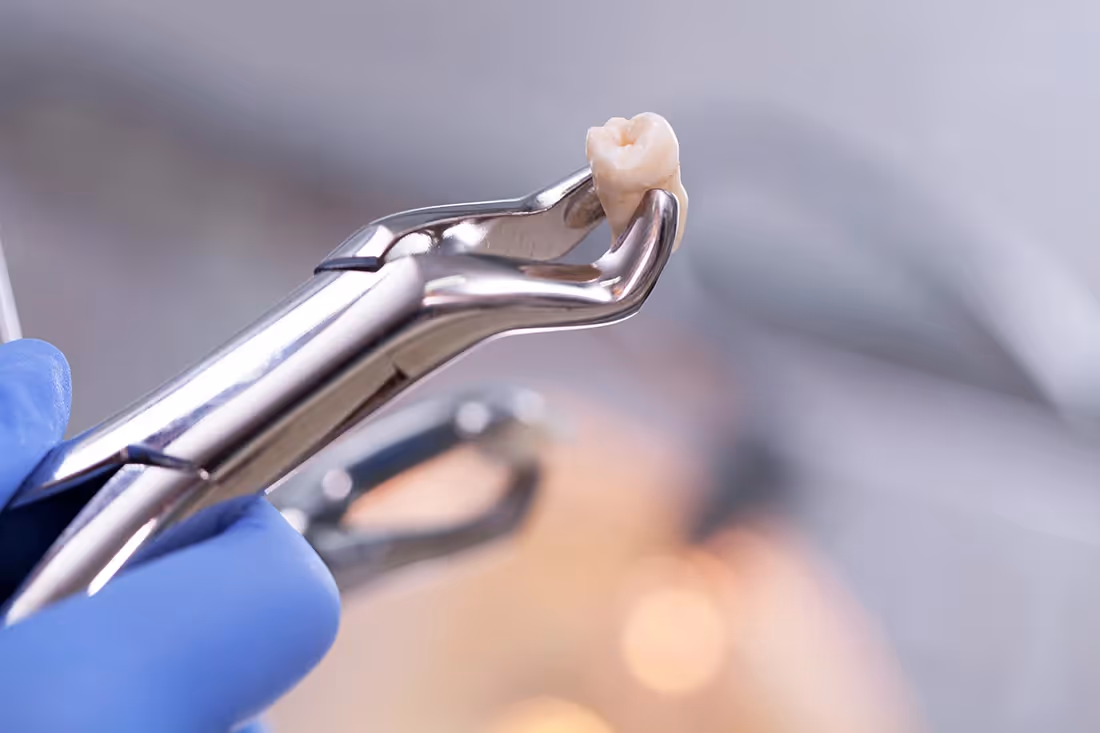 Dublin Tooth Extractions