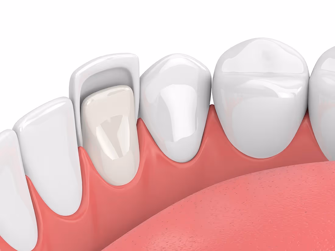 Veneers in Dublin, OH | Dublin Smiles