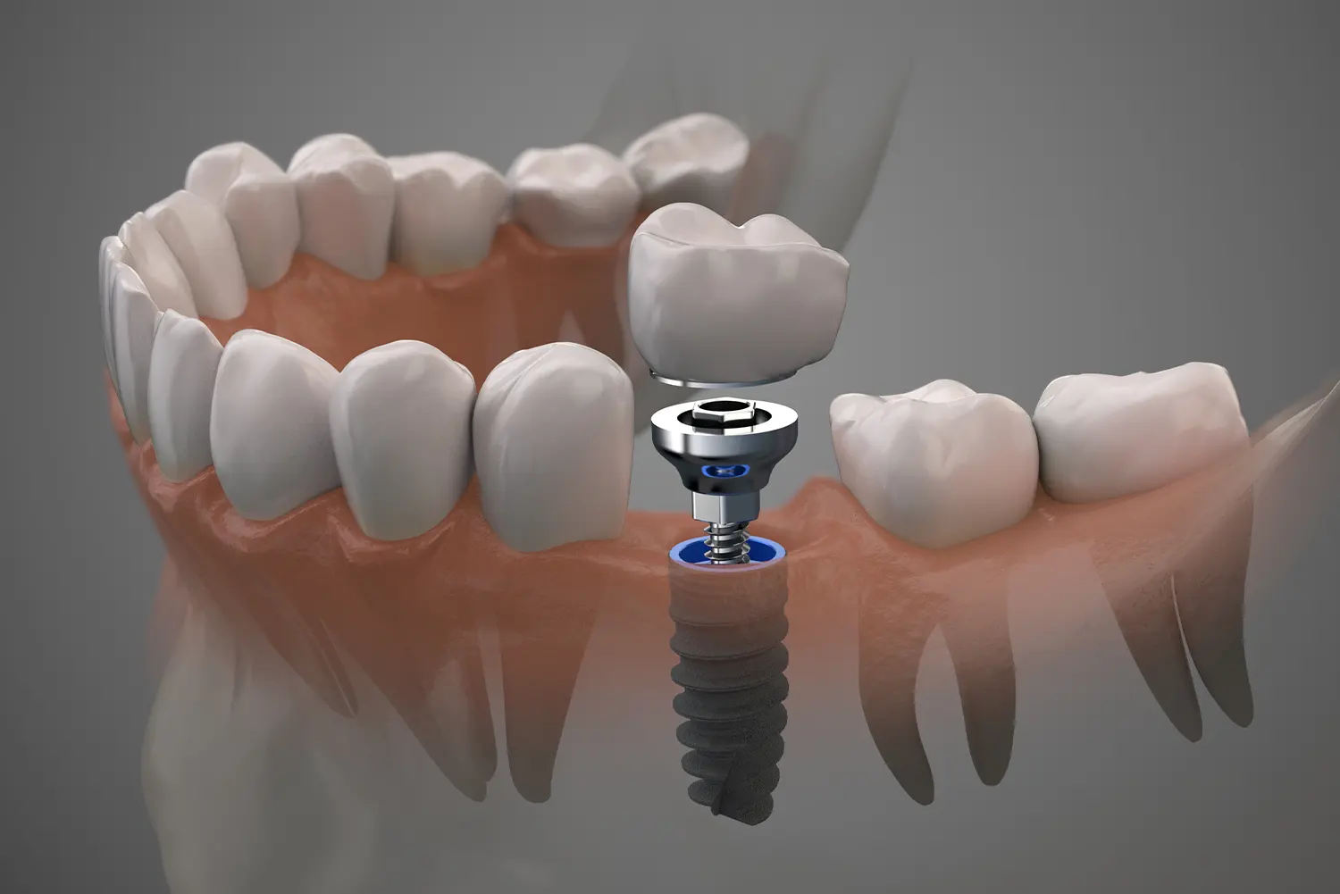 Dental Implants in Downtown Austin | Primavera Dental Group